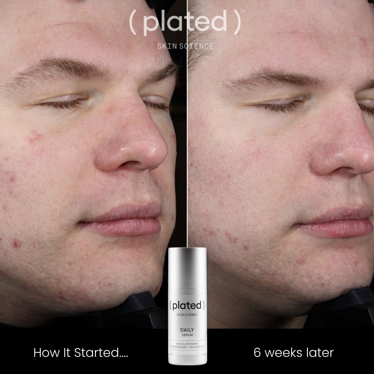 Before-and-after comparison of a man's face after 6 weeks of use of the ( plated )® Skin Science 30 mL DAILY Serum
