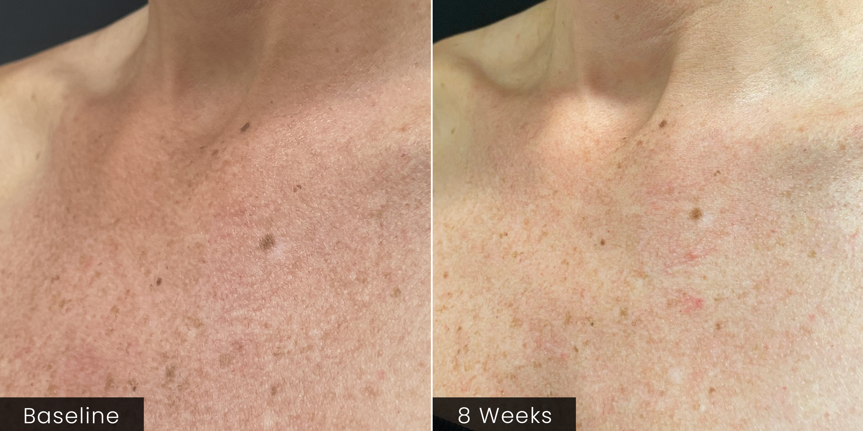 Side-by-side close-up of a person's chest and neck area labeled 'Baseline' and '8 Weeks' to show the appearance of skin texture and pigmentation improvement over time.