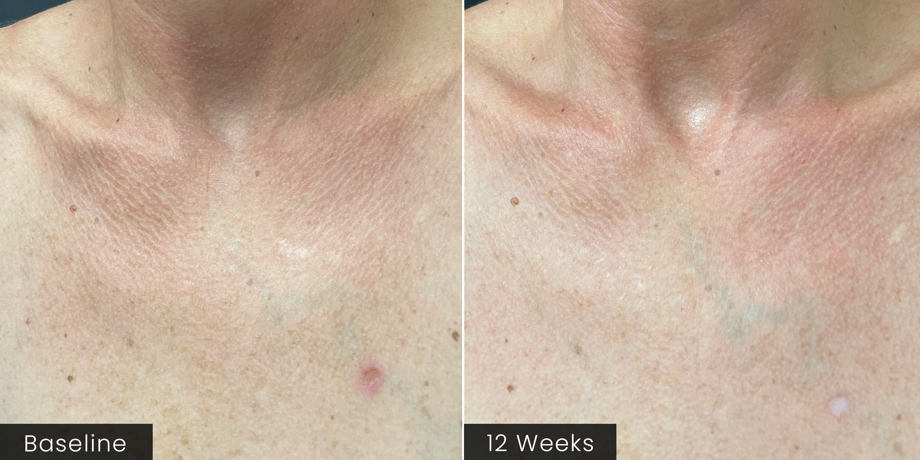 A side-by-side before-and-after comparison of skin texture on the chest and the appearance of reduced pigmentation and dark spots, labeled 'Baseline' on the left and '12 Weeks' on the right.