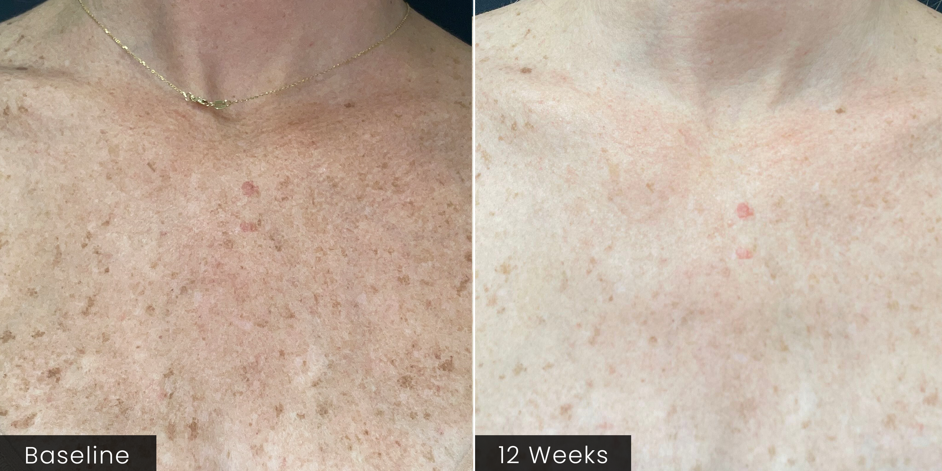 A side-by-side close-up of skin labeled 'Baseline' on the left and '12 Weeks' on the right, showing a before-and-after comparison of the appearance of improved skin texture and coloration.
