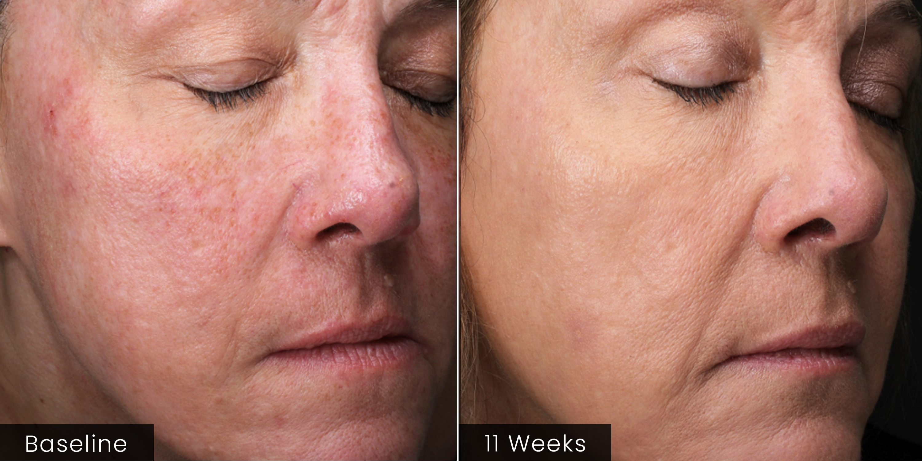 Before and after comparison of a person's face with visible skin improvement over 11 weeks.