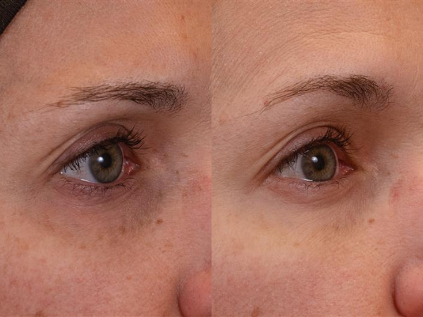 Before and after of eye area following EYE Serum use showing the reduced appearance of fine lines.