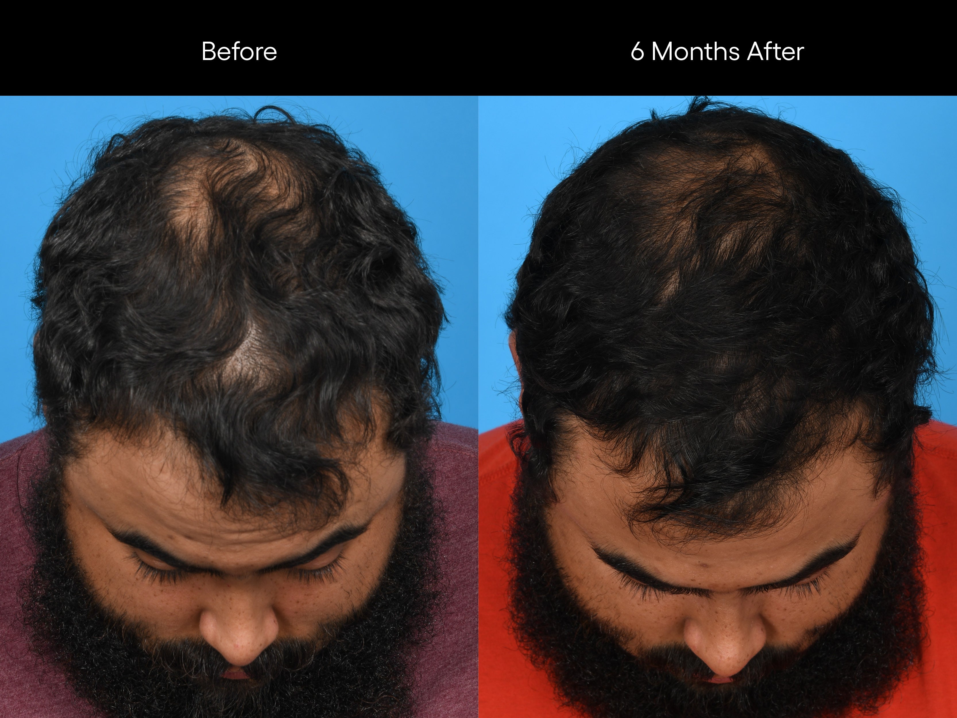 Before and after comparison of a person's head/scalp with visible improvement in density over 6 months.