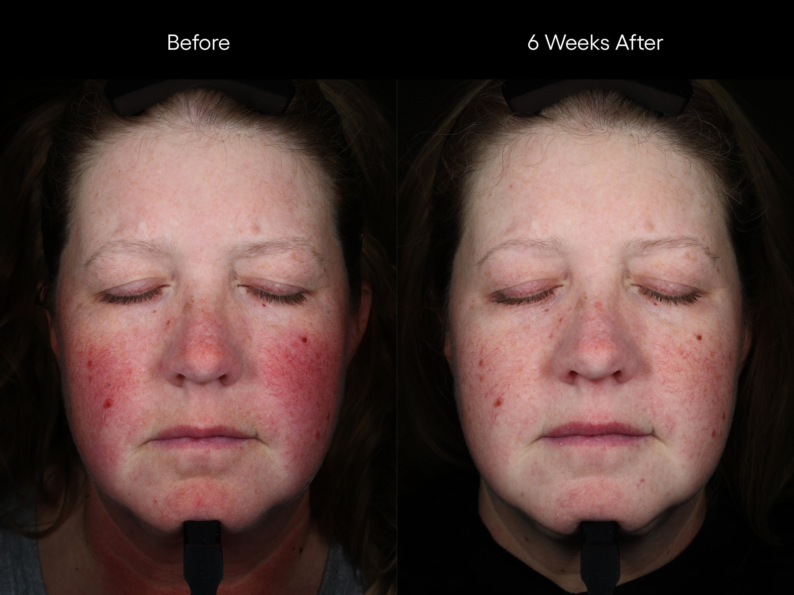 Before and after comparison of a person's face with visible skin improvement and reduction in redness over 6 weeks.