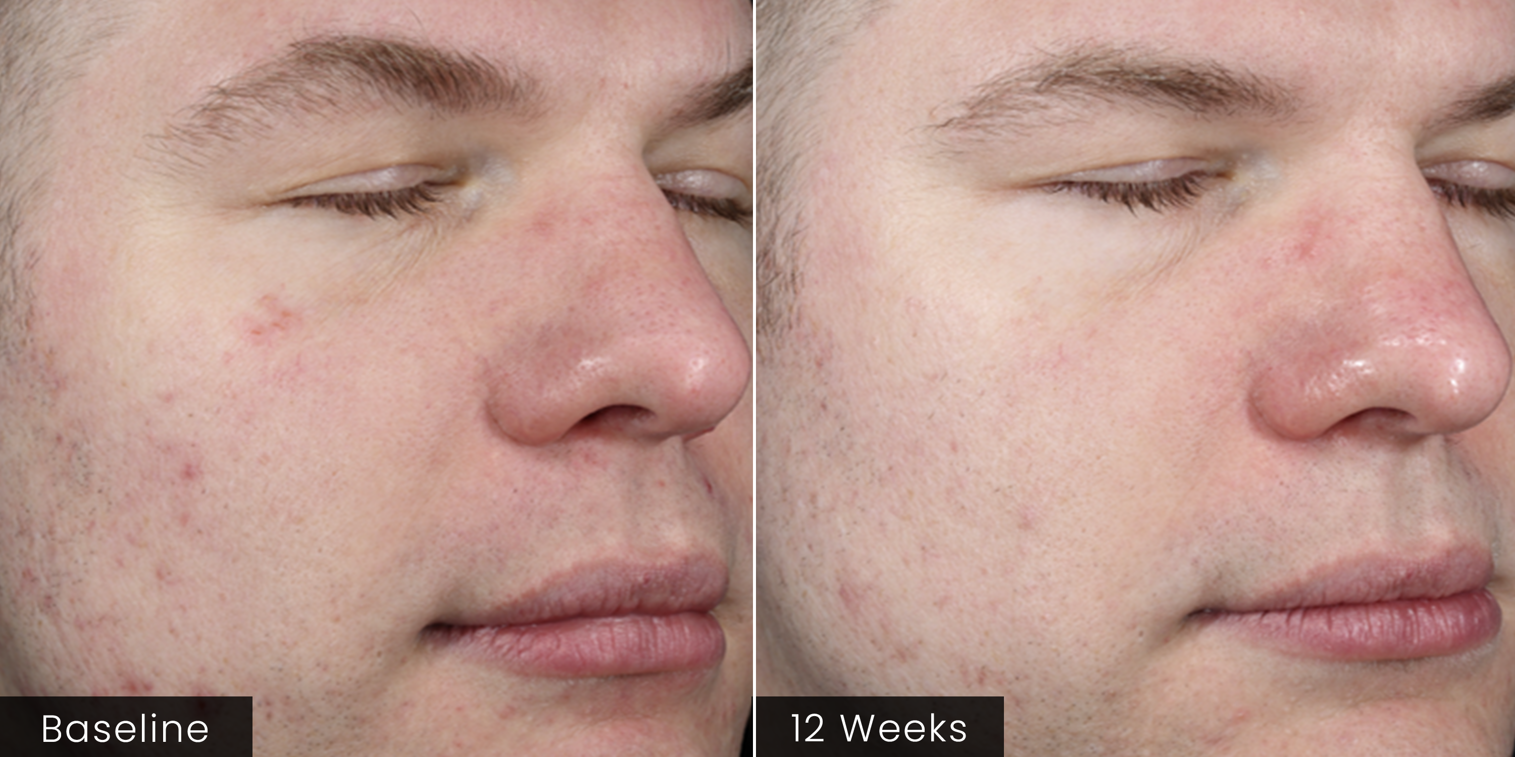 Before-and-after comparison of a man's face showing visible skin barrier improvement over 12 weeks.