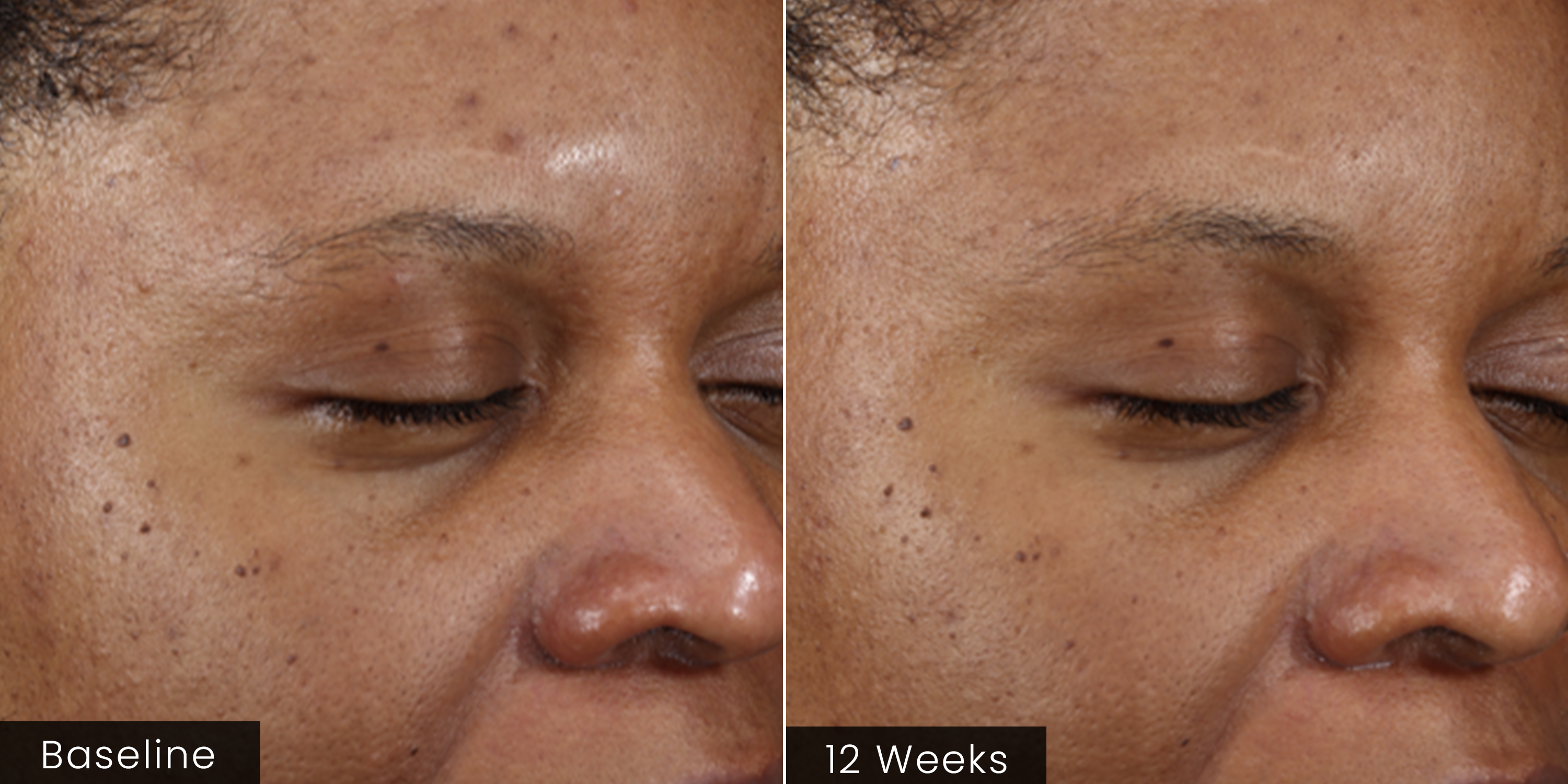Before and after comparison of a person's face with visible skin texture changes over 12 weeks.