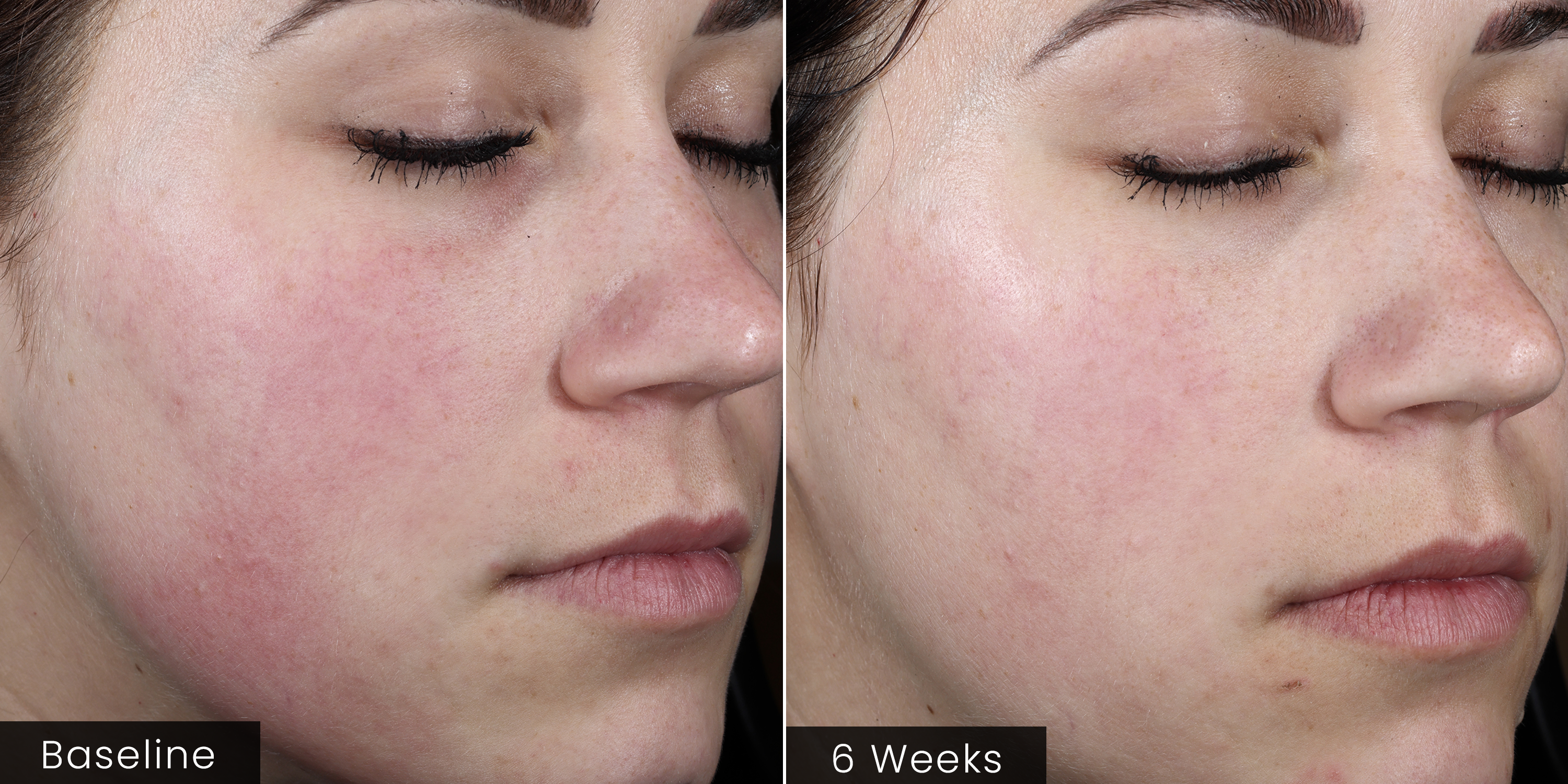 Before and after comparison of a person's face, showing visible improvement over 6 weeks.