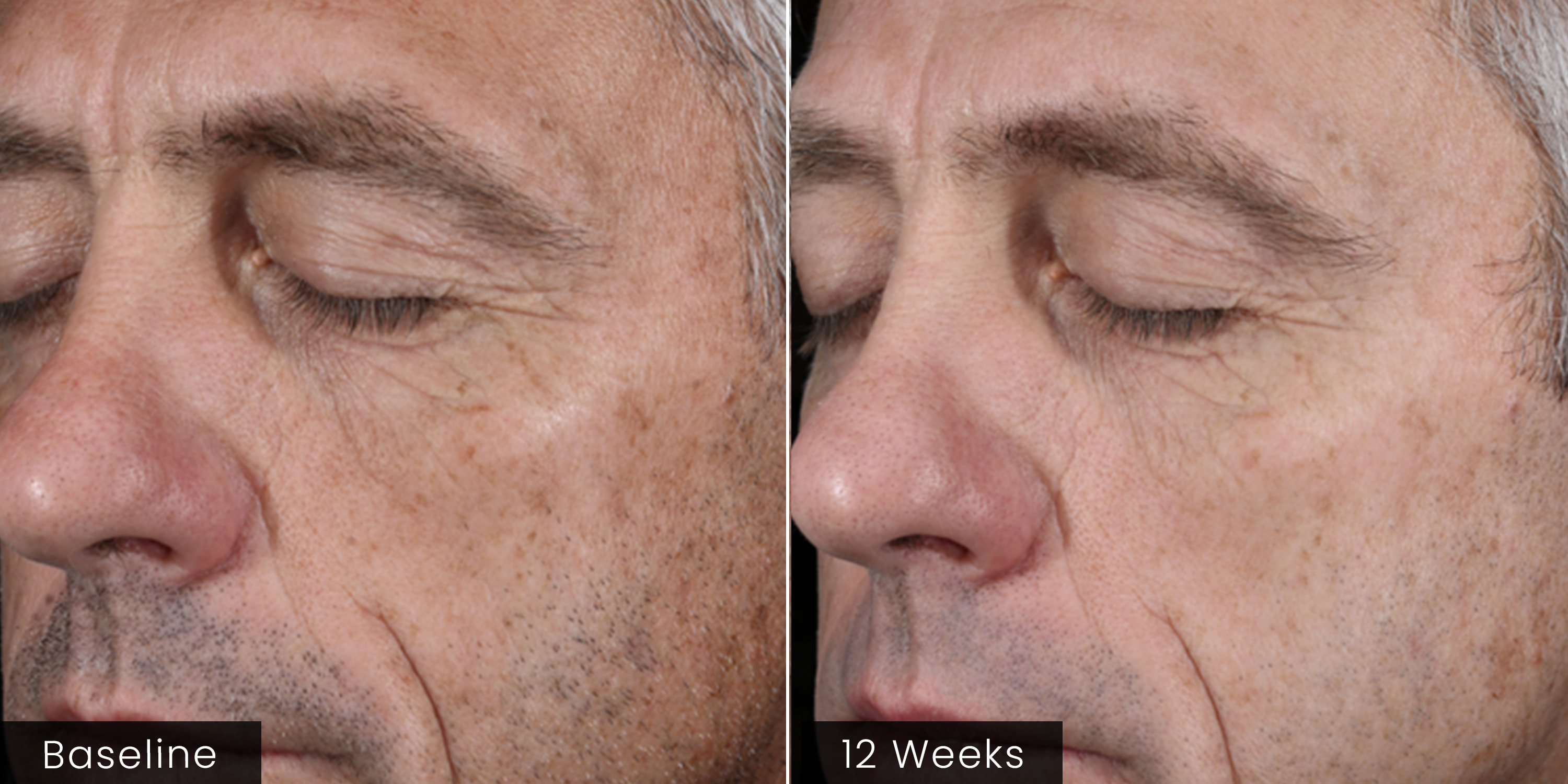 Before and after comparison of a man's face with visible skin texture changes over 12 weeks.