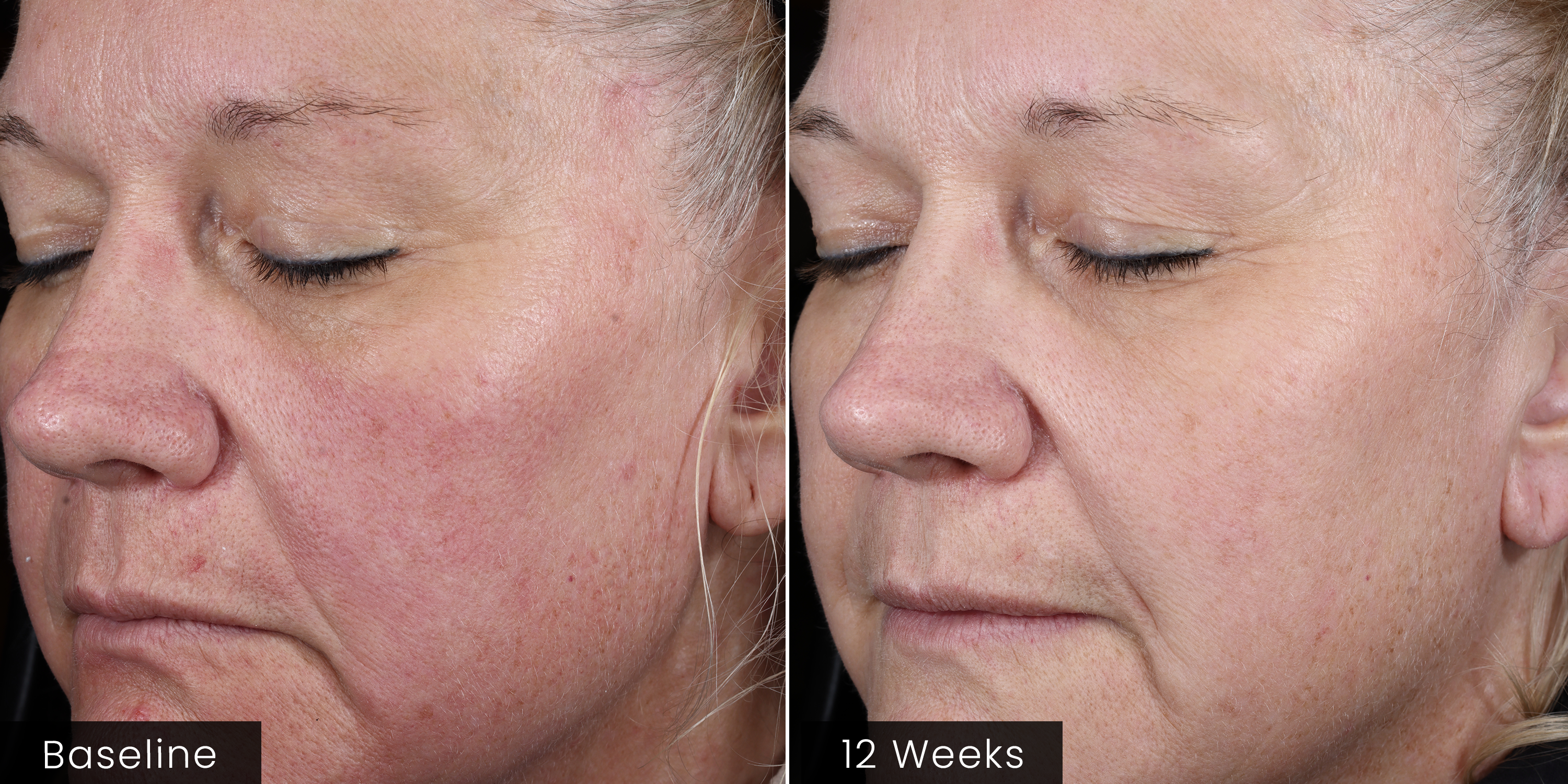 Before and after comparison of a woman's face with visible skin texture changes over 12 weeks.